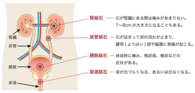 症状 結石 腎臓結石の症状や原因【ストレスや食事？】治療・予防法