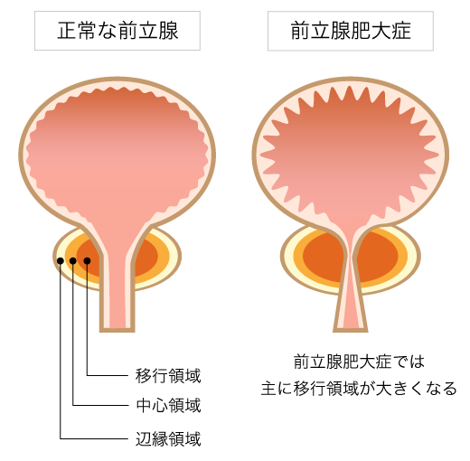 前立腺肥大症